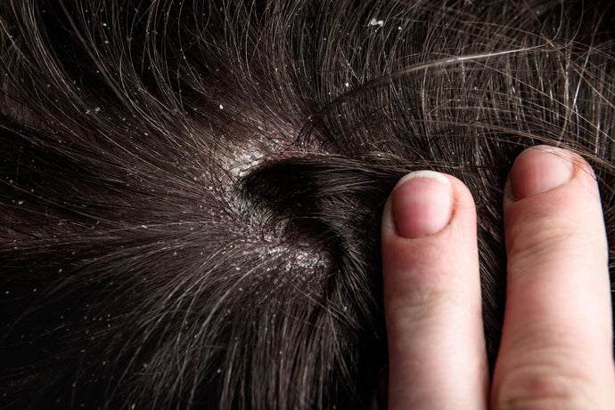 Can Dry Scalp Cause Hair Loss? Find Out Now!