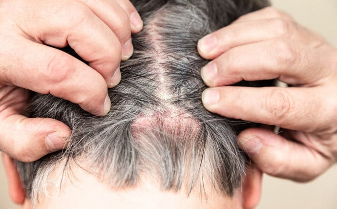 How To Get Rid of Psoriasis on Scalp