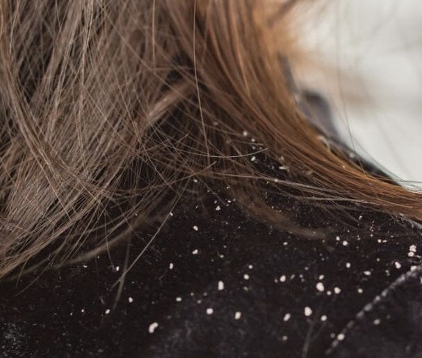 Managing Chronic Dandruff: Causes, Treatments, and Lifestyle Changes